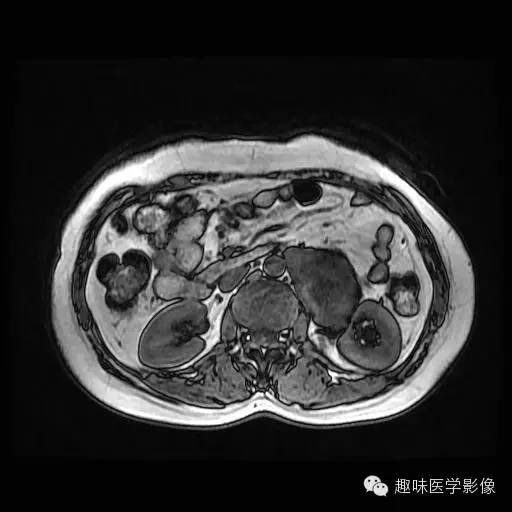 【病例】肾神经鞘瘤1例MR影像表现
