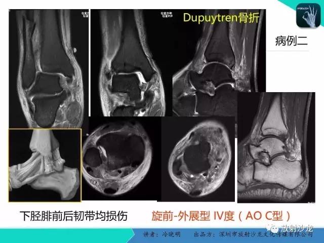 【PPT】基于损伤机制的踝关节急性损伤的影像学评估