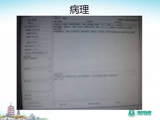 【PPT】骨肉瘤的影像诊断