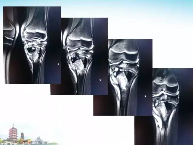 【PPT】骨肉瘤的影像诊断