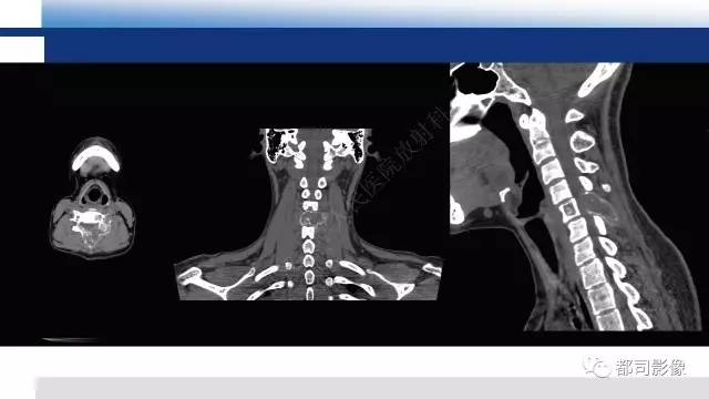 【PPT】脊柱良性肿瘤及肿瘤样病变影像诊断