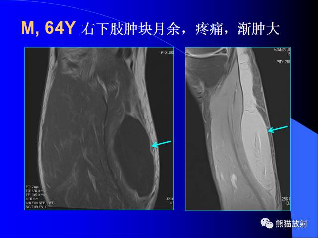 【PPT】膝关节周围囊肿MRI 【PPT】膝关节周围囊肿MRI