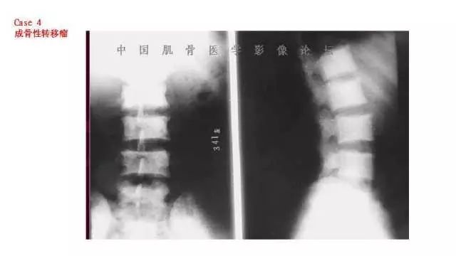 【PPT】常见骨骼病变的诊断与鉴别诊断