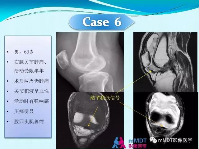 【PPT】膝关节色素沉着绒毛结节性滑膜炎影像表现PVNS