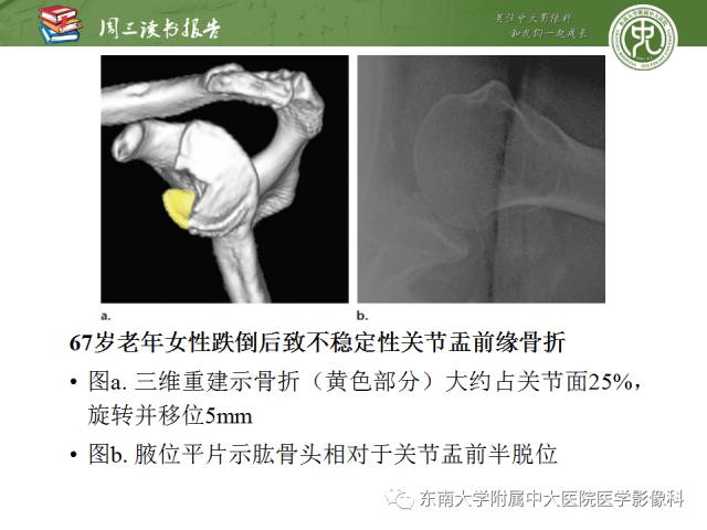 【PPT】急性肩关节损伤：外科医生想获知的内容