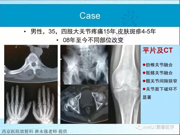 【PPT】骶髂关节非肿瘤病变的影像诊断