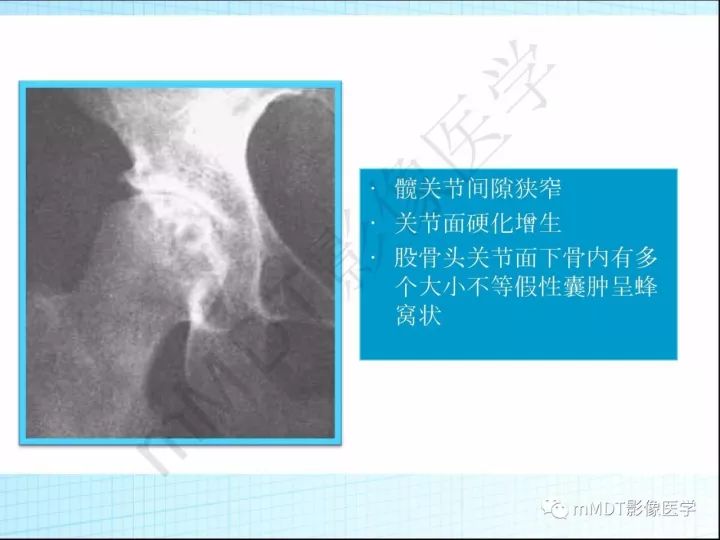 【PPT】骶髂关节非肿瘤病变的影像诊断