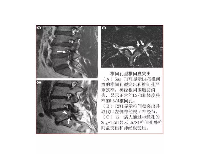 【PPT】腰椎退行性疾病影像学诊断