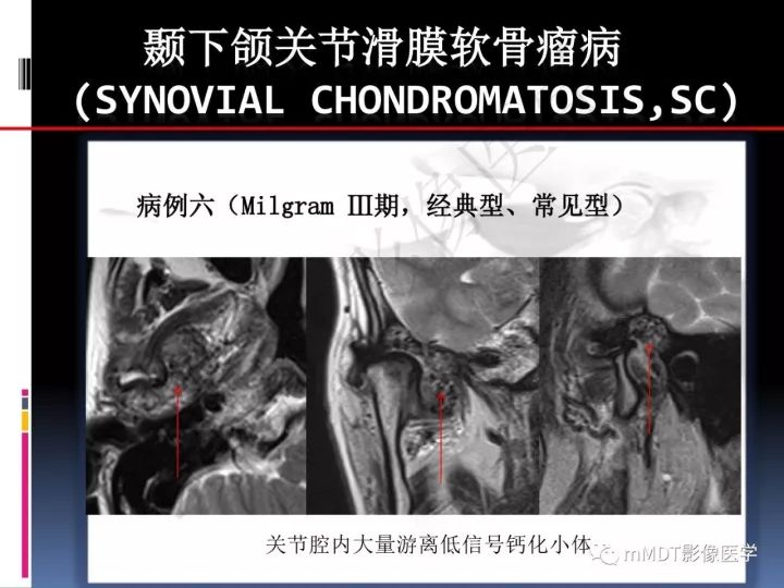 【PPT】颞下颌关节滑膜骨软骨瘤病MR分期诊断