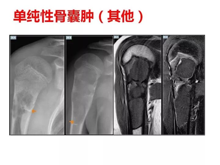 【PPT】良恶性骨肿瘤的影像诊断和图像特征