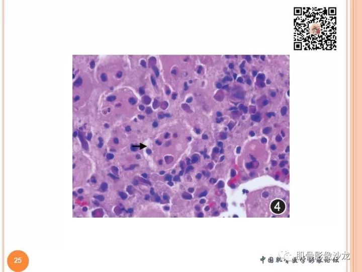 【PPT】骨与软组织Rosai-Dorfman病