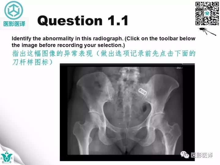 【病例】骨促结缔组织增生性纤维瘤1例X线MR