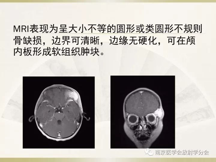 【病例】肱骨嗜酸性肉芽肿1例X线CT及MR影像表现