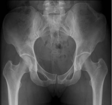 38种特殊类型的骨折