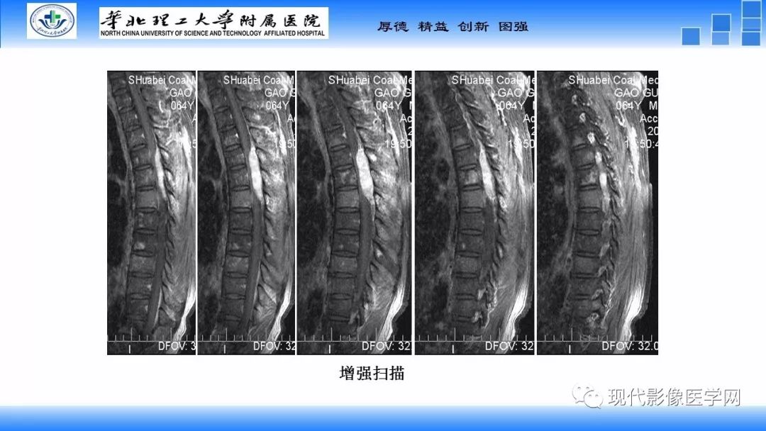 【病例】椎管内原始神经外胚层肿瘤1例CT及MR