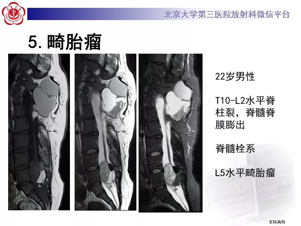 【病例】椎管内髓外硬膜下畸胎瘤1例