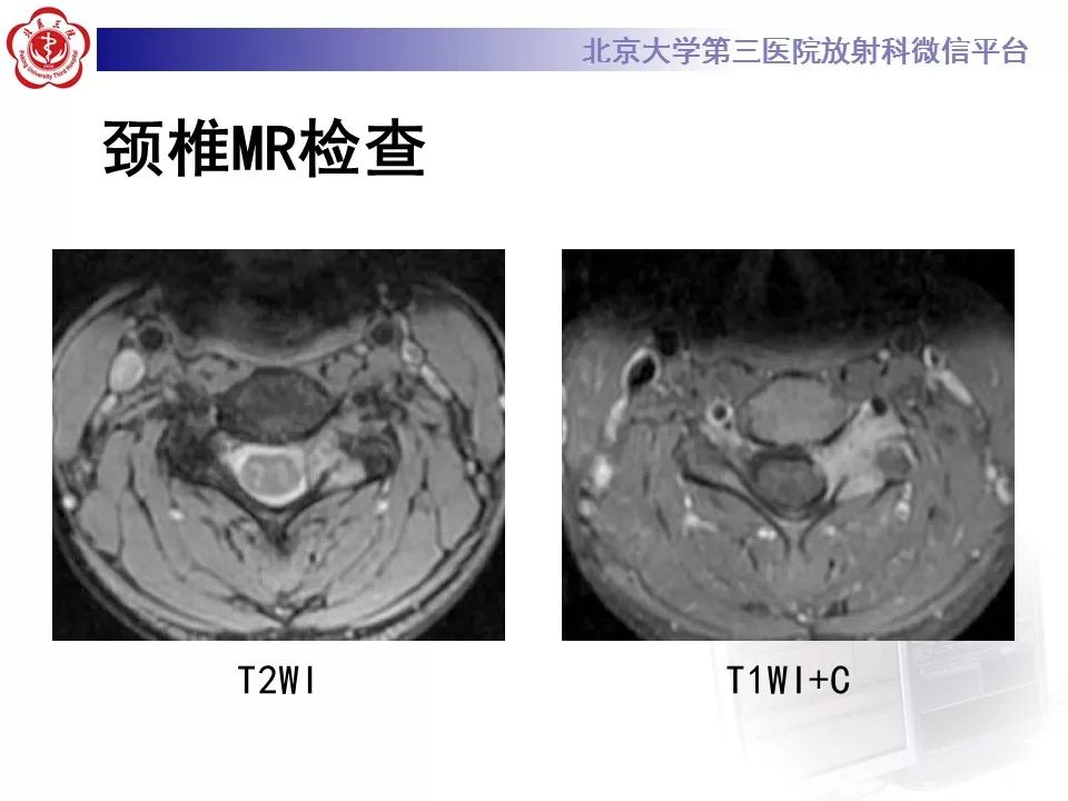 【病例】脊柱腱鞘巨细胞瘤1例CT及MR影像诊断