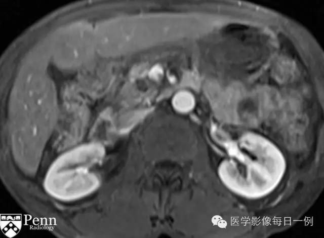 【病例】沟槽状/局限性胰腺炎1例CT影像表现