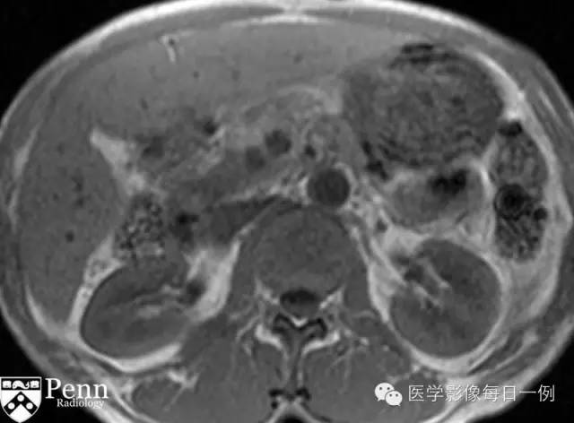 【病例】沟槽状/局限性胰腺炎1例CT影像表现