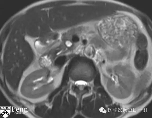 【病例】沟槽状/局限性胰腺炎1例CT影像表现