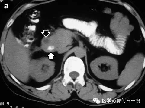 【病例】沟槽状/局限性胰腺炎1例CT影像表现