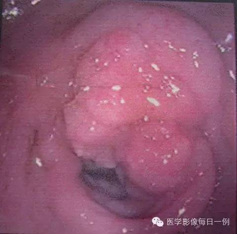 【病例】沟槽状/局限性胰腺炎1例CT影像表现