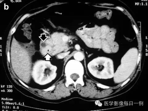 【病例】沟槽状/局限性胰腺炎1例CT影像表现