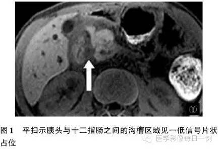【病例】沟槽状/局限性胰腺炎1例CT影像表现
