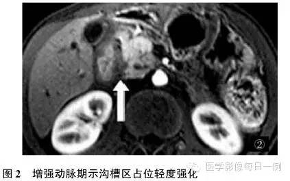 【病例】沟槽状/局限性胰腺炎1例CT影像表现
