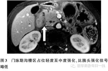 【病例】沟槽状/局限性胰腺炎1例CT影像表现