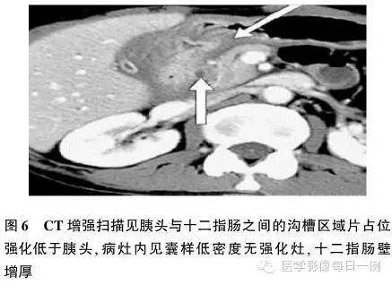 【病例】沟槽状/局限性胰腺炎1例CT影像表现