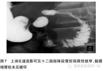 【病例】沟槽状/局限性胰腺炎1例CT影像表现