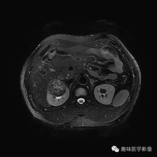 【病例】肾细胞癌1例MR影像表现