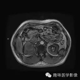 【病例】肾细胞癌1例MR影像表现