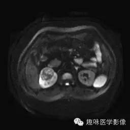 【病例】肾细胞癌1例MR影像表现