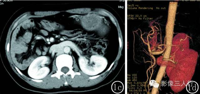 【病例】成人多脾综合征2例
