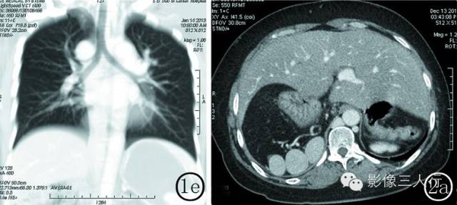【病例】成人多脾综合征2例