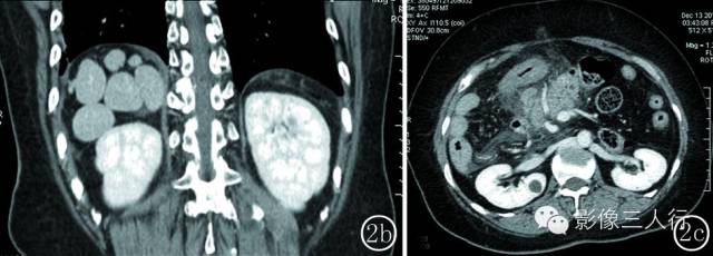 【病例】成人多脾综合征2例