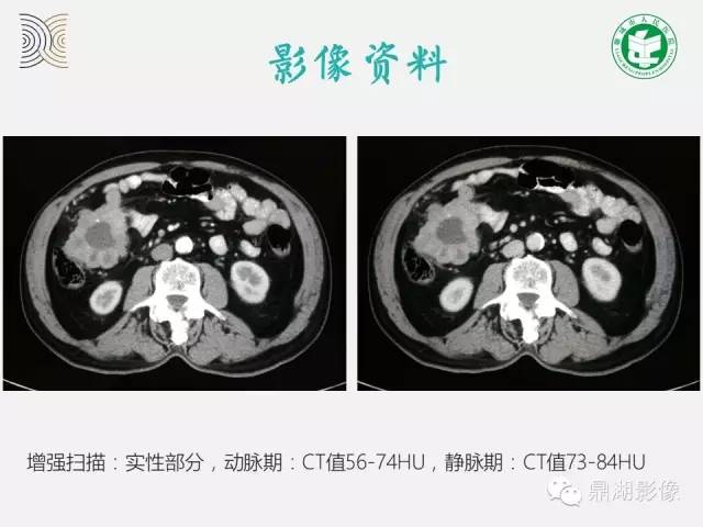 【病例】小肠胃肠道间质瘤1例CT影像表现