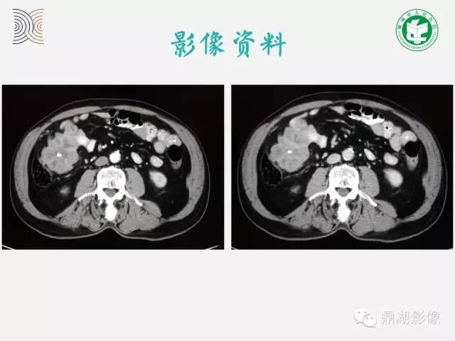 【病例】小肠胃肠道间质瘤1例CT影像表现