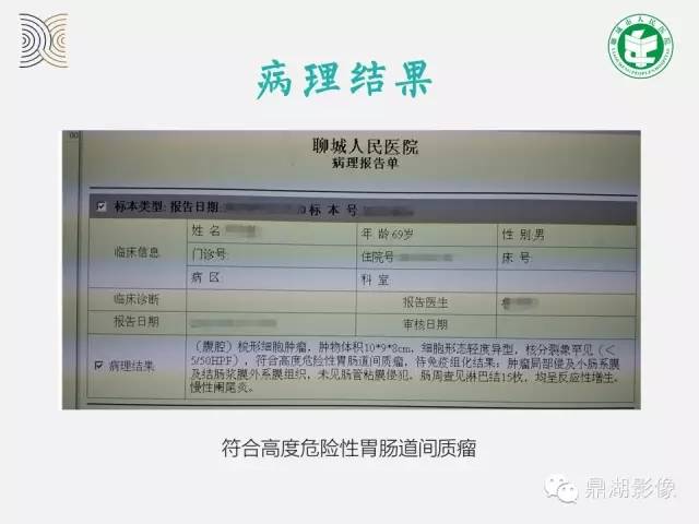【病例】小肠胃肠道间质瘤1例CT影像表现