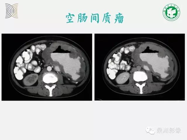 【病例】小肠胃肠道间质瘤1例CT影像表现