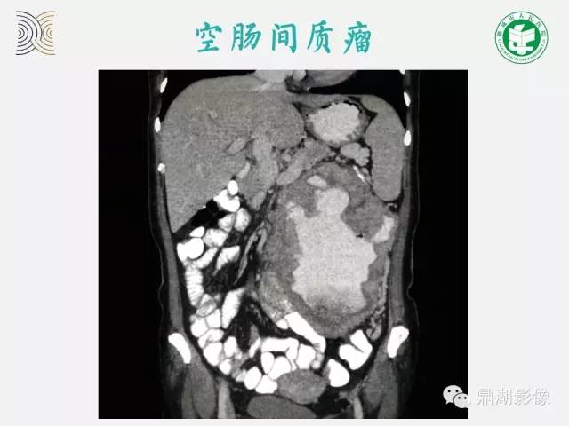 【病例】小肠胃肠道间质瘤1例CT影像表现