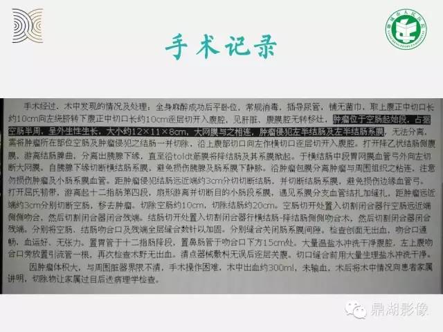 【病例】小肠胃肠道间质瘤1例CT影像表现