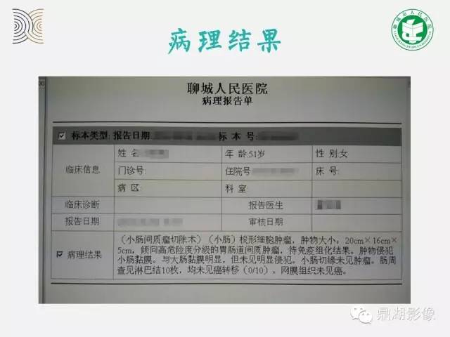 【病例】小肠胃肠道间质瘤1例CT影像表现