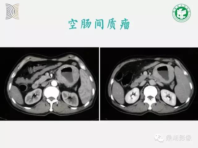 【病例】小肠胃肠道间质瘤1例CT影像表现