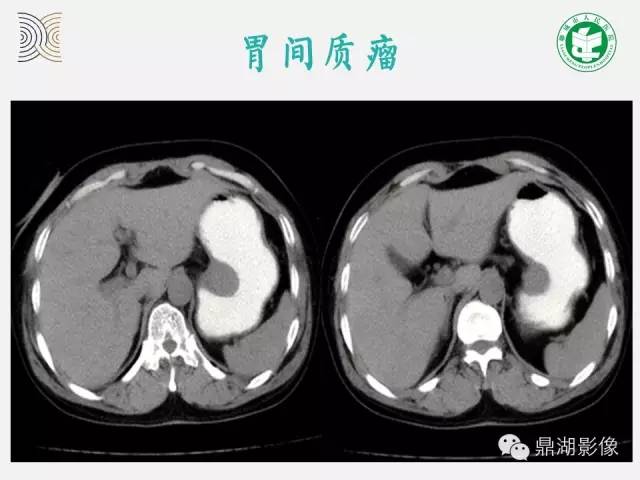 【病例】小肠胃肠道间质瘤1例CT影像表现