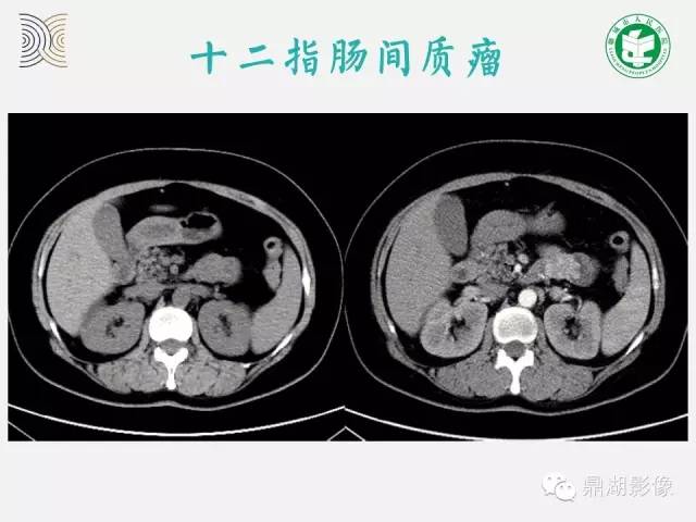 【病例】小肠胃肠道间质瘤1例CT影像表现