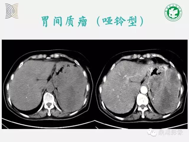 【病例】小肠胃肠道间质瘤1例CT影像表现