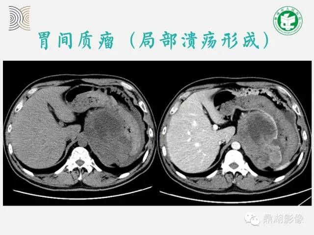 【病例】小肠胃肠道间质瘤1例CT影像表现